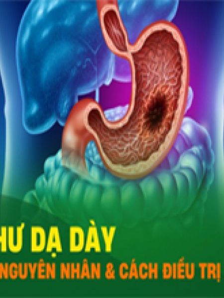 UNG THƯ DẠ DÀY: NGUYÊN NHÂN, TRIỆU CHỨNG, ĐIỀU TRỊ VÀ PHÒNG NGỪA