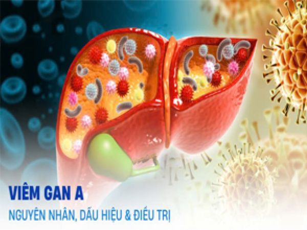 VIÊM GAN A: CÁCH ĐIỀU TRỊ VÀ PHÒNG NGỪA