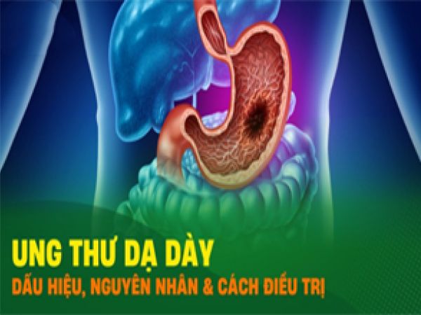 UNG THƯ DẠ DÀY: NGUYÊN NHÂN, TRIỆU CHỨNG, ĐIỀU TRỊ VÀ PHÒNG NGỪA